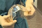 Хирурги совершили пересадку человеку черепа, напечатанного на 3D-принтере
