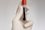 Анализ крови поможет обнаружить рак яичников